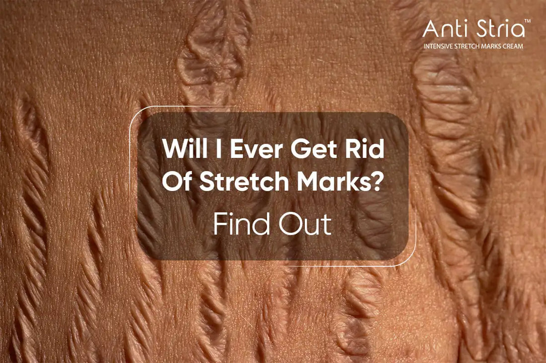 Are Stretch Marks Permanent?