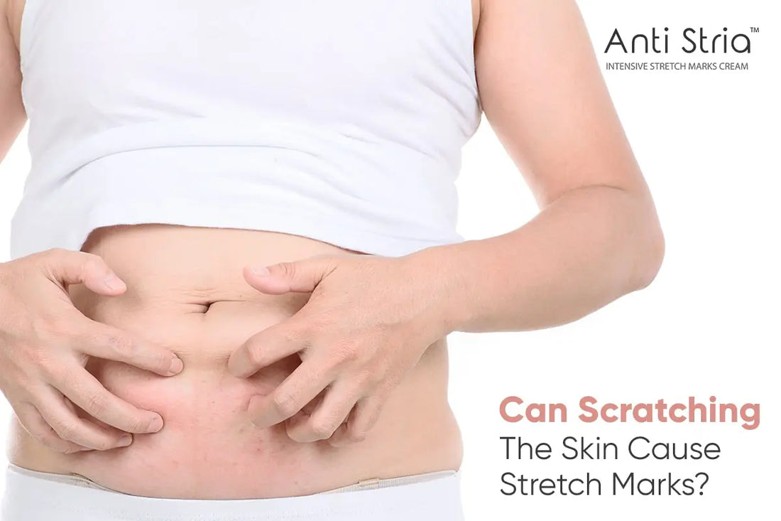 Are Stretch Marks and Scratching Related? Truth Revealed
