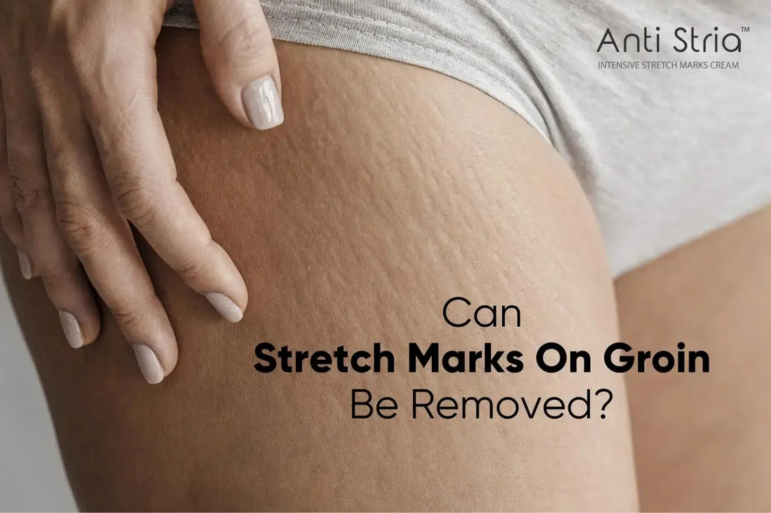How Do I Get Rid Of The Stretch Marks That Are Growing On My Groin?