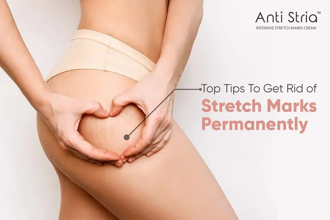 Unlocking The Secrets: How To Get Rid of Stretch Marks Permanently