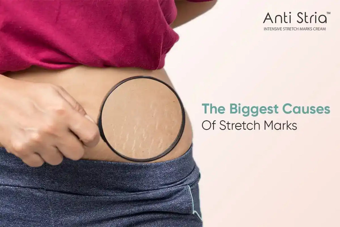 Unveiling The Mystery: Reasons For Stretch Marks You Need to Know