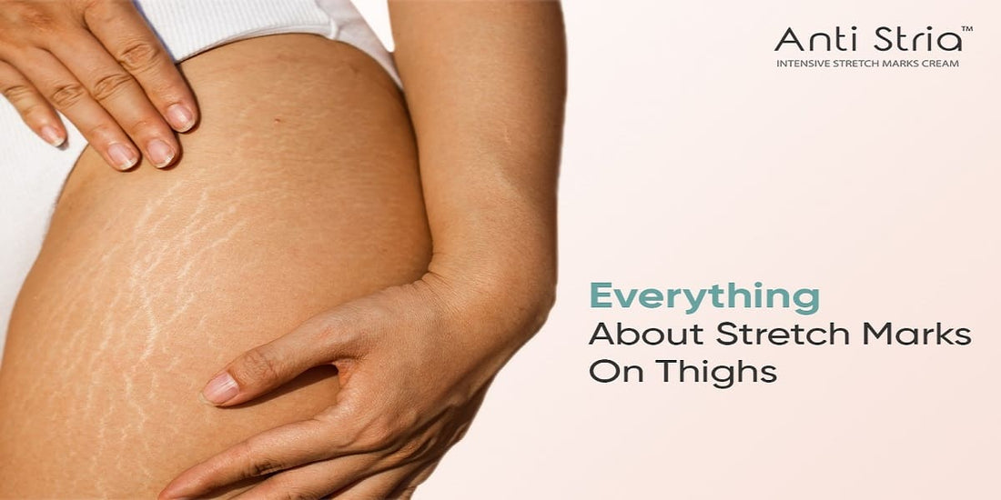 Thigh Stretch Marks: Embracing Solutions for Beautiful Legs
