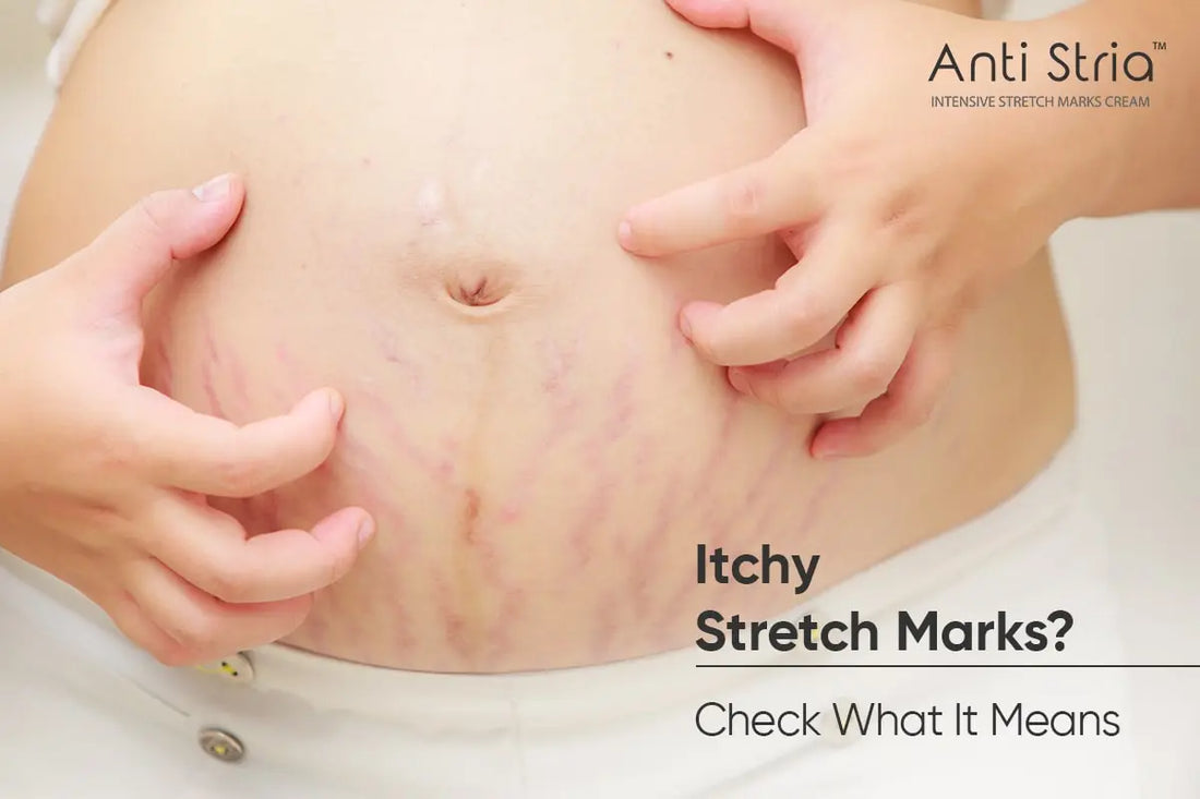 Are Your Stretch Marks Itchy? Best Solution Revealed