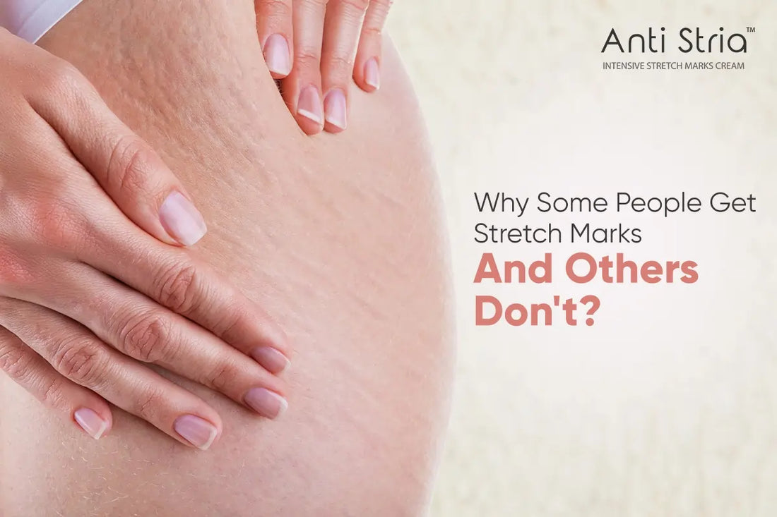 Revealed: Why Some People Never Get Stretch Marks