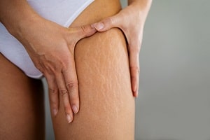 Puberty Stretch Marks