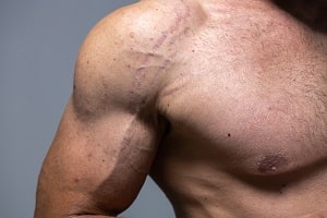 Puberty Stretch Marks