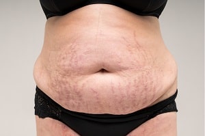 Puberty Stretch Marks