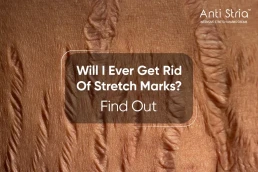 Anti Stria Best Cream for Permanent Stretch Marks