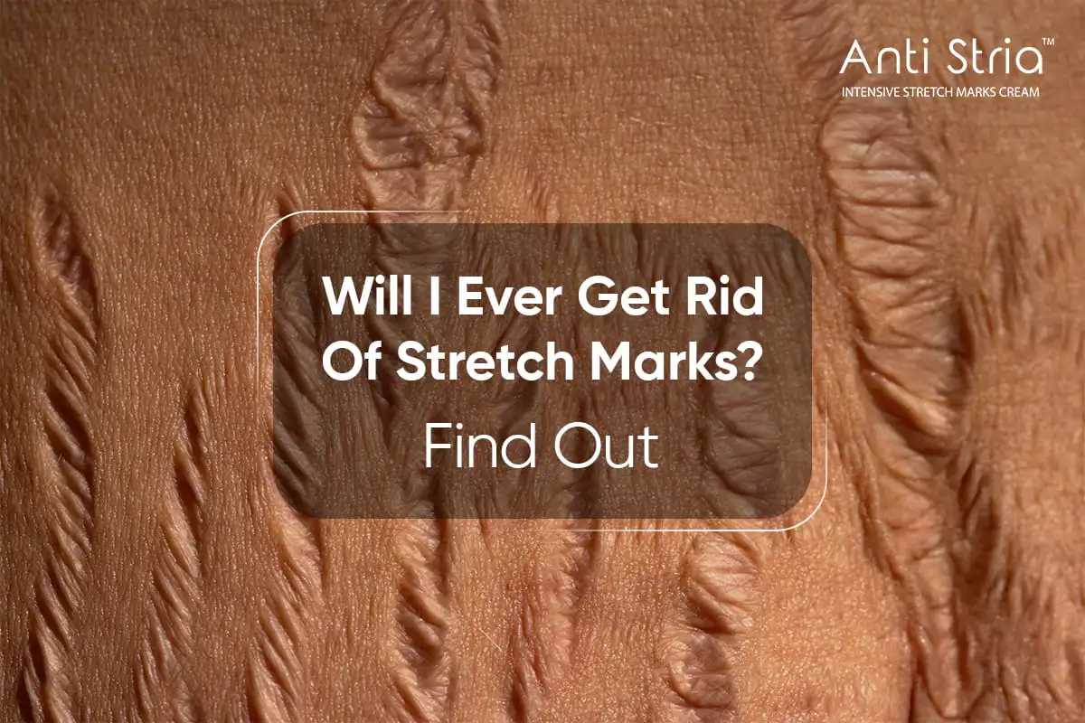 Are Stretch Marks Permanent
