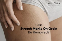 Anti Stria Stretch Marks Removal Cream for Growing on my Groin