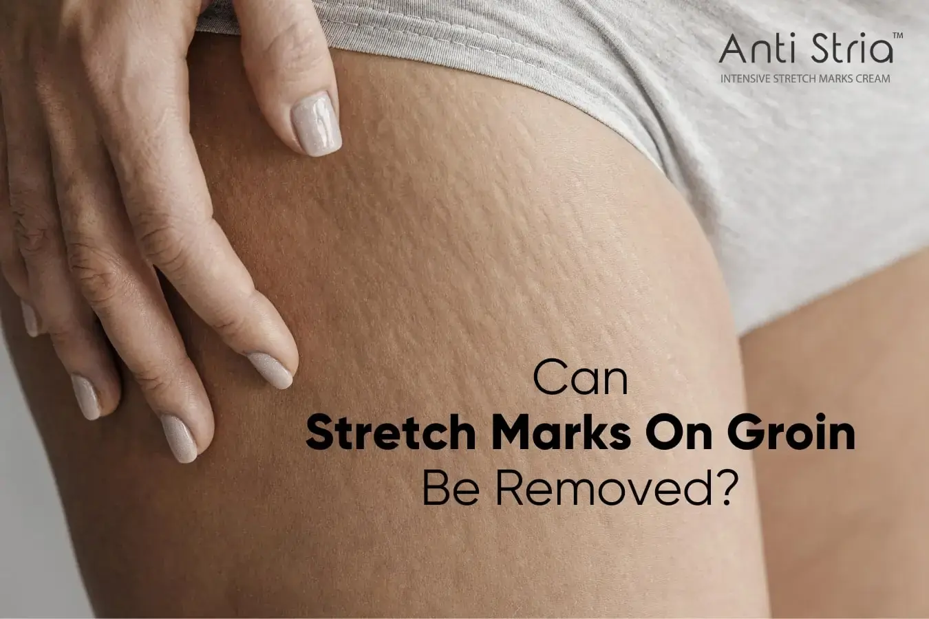 HOW TO REMOVE STRETCH MARKS APPEARING ON MY GROIN