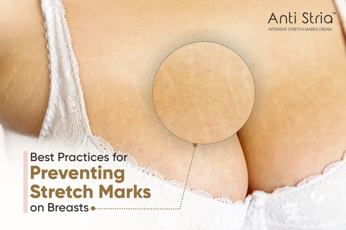 Remove Stretch Marks on Breasts with Anti Stria Cream