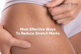 How Anti Stria Stretch Marks Removal Cream is Important