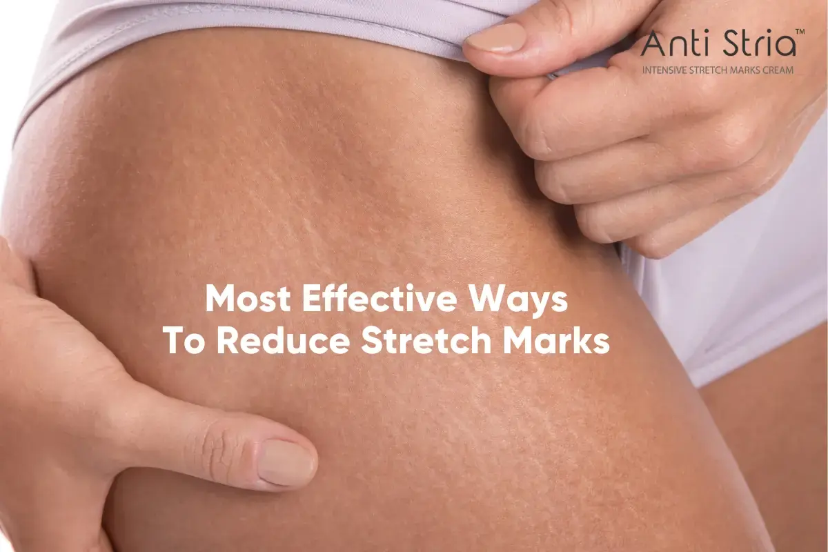 Most Effective Method to Reduce Stretch Marks