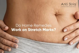 Anti Stria Stretch Marks Removal Cream & HOME REMEDIES FOR STRETCH MARKS