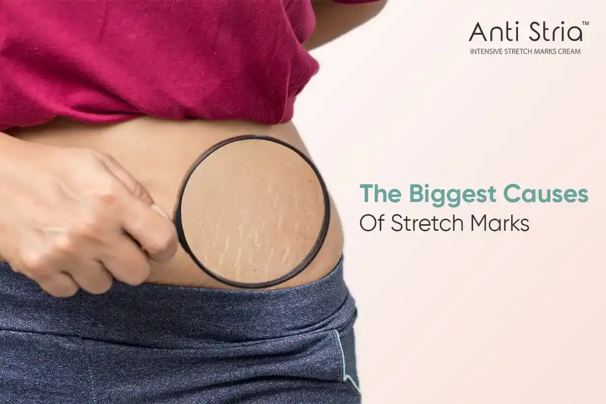 Stretch marks Why they appear