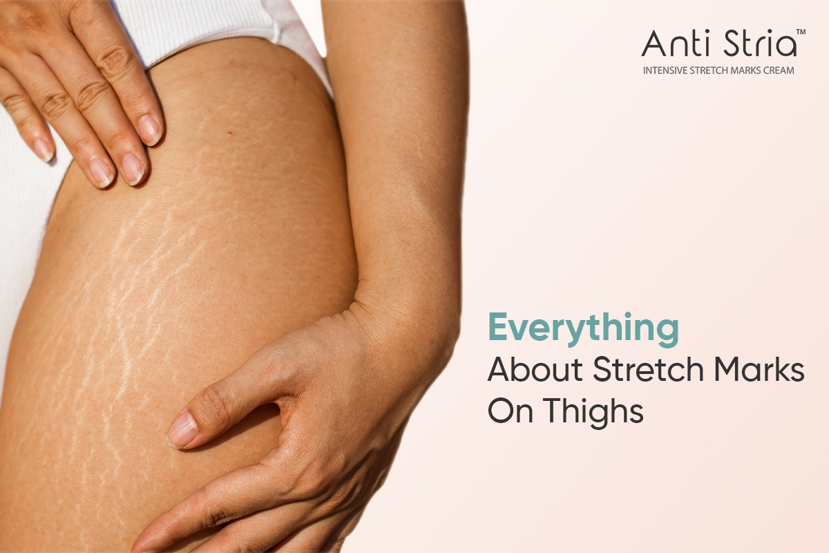 Stretch marks on thighs Appearance