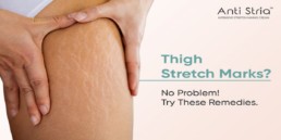 Thigh Stretch Marks Cream