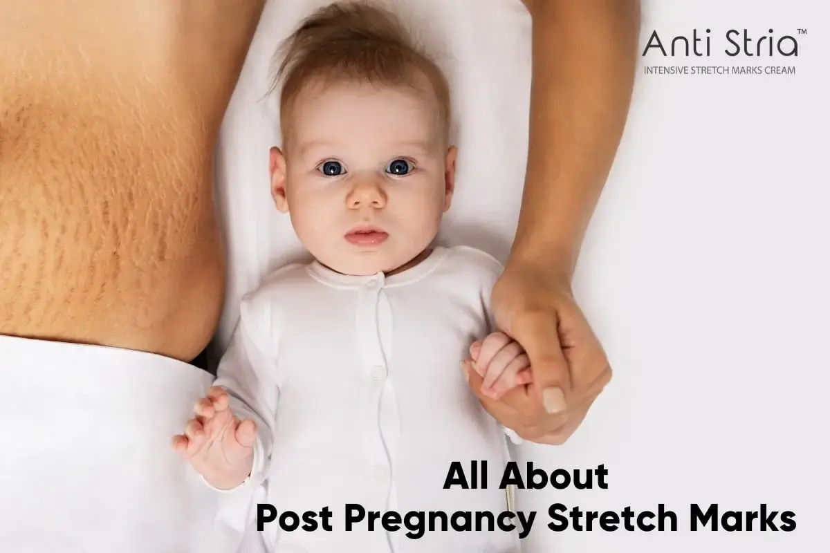 WHAT TO KNOW ABOUT STRETCH MARKS AFTER PREGNANCY