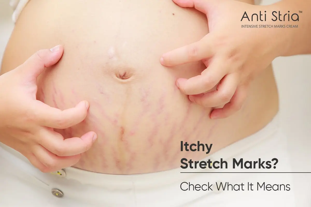 Are Your Stretch Marks Itchy