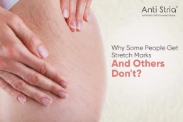 Use Anti Stria Cream to Remove Stretch Marks Effectively