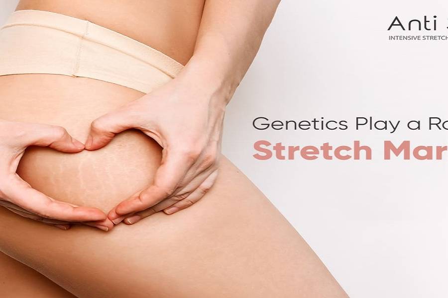 genetic stretch marks